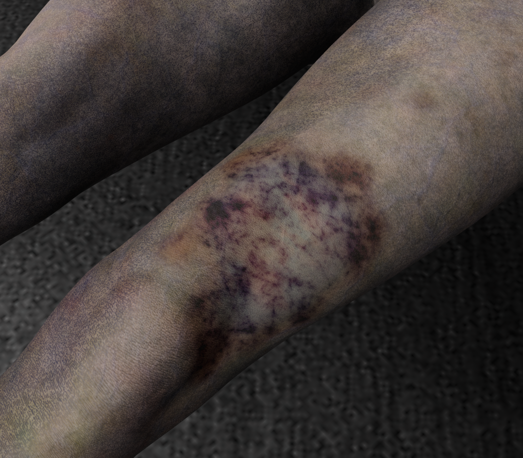 Bruised Leg