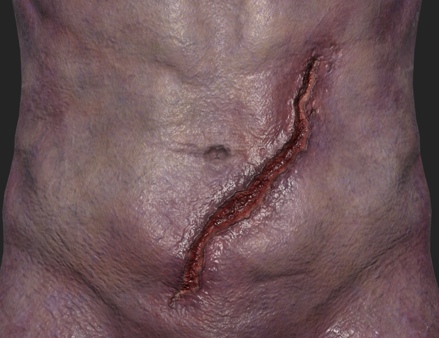 Abdominal Laceration