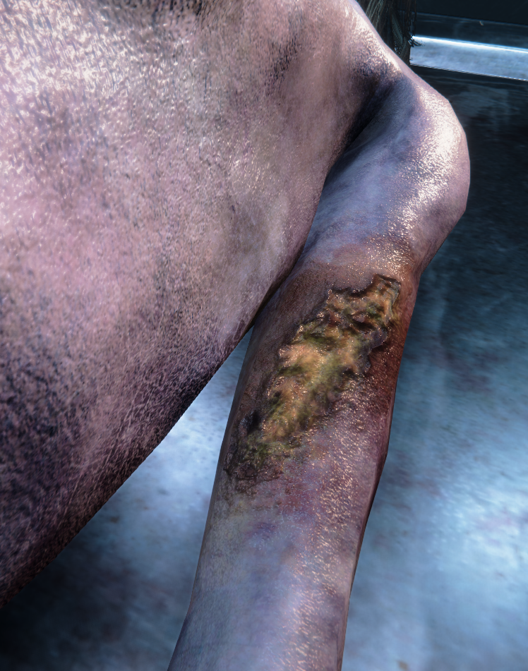 Infected Wound