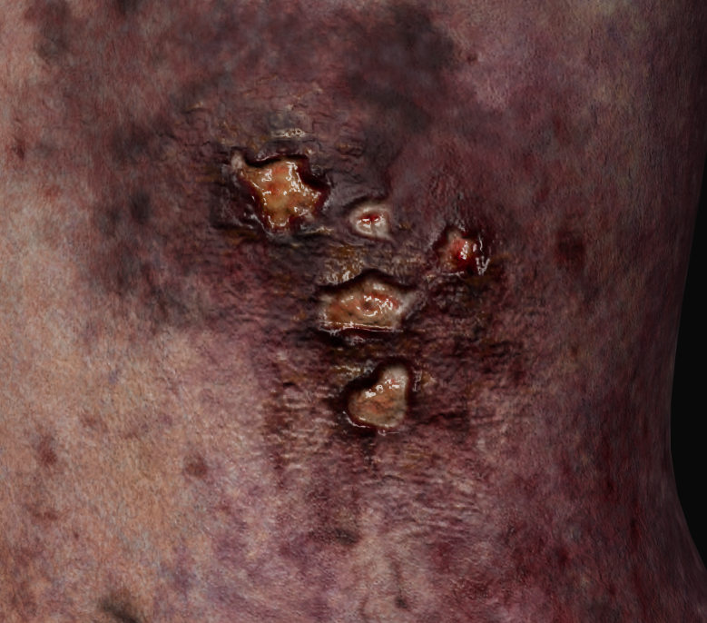 Infected Wound Detail