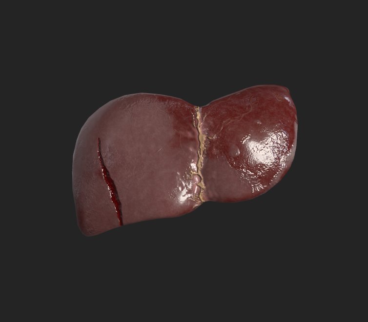 Liver with Laceration