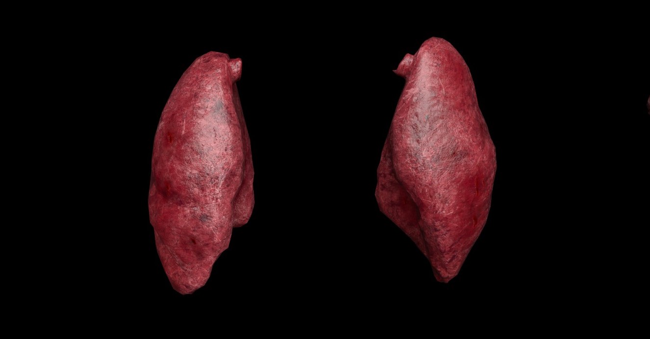 Lungs Infected and Hemorrhaged