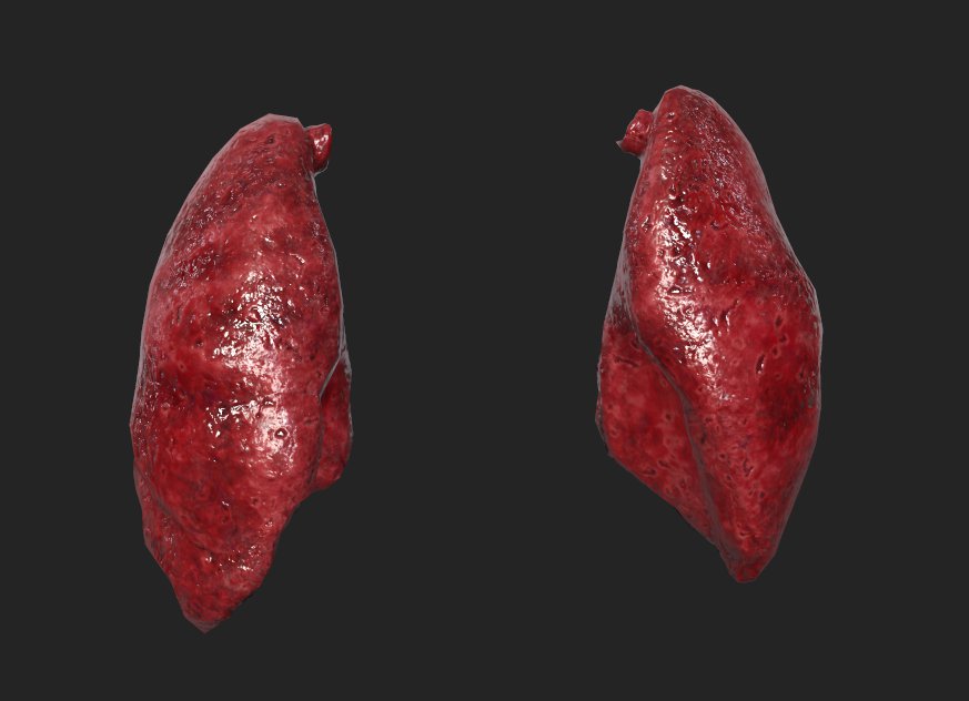 Lungs with Pulmonary Fibrosis